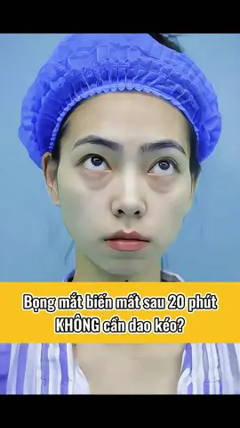 TỪ MẮT LỪ ĐẾN MẮT THƯỢNG ĐẲNG CHỈ SAU 20 PHÚT? #nangtamsacdepviet #laymobongmatnoisoi #phauthuatthammy #fyp #pttm #beaty #beatytips 