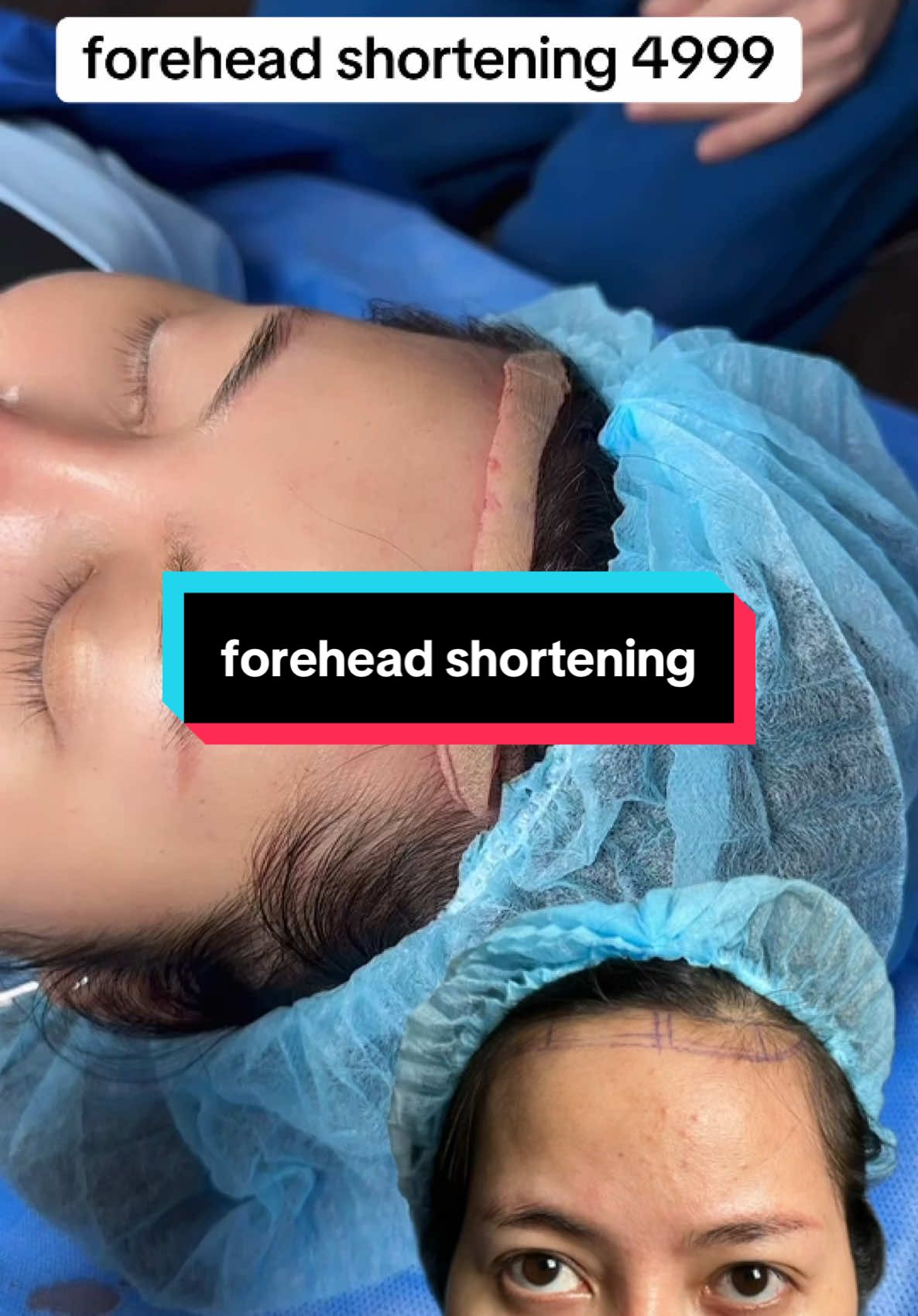 forehead shortening#tikktokmalaysia🇲🇾 #tiktokindonesia #eyes #rhinoplasty #hidung #facelift #chinimplant #tiktokviral #TikTokLIVE #implant #johorbahrumalaysia🇲🇾 #browlift #indonesia #comedia #browntiktok #fby #nosewing #fyb 