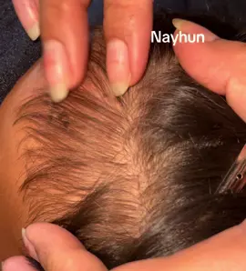 Lice #😳😲😳 #itchy #liceremoval #tripofobia 