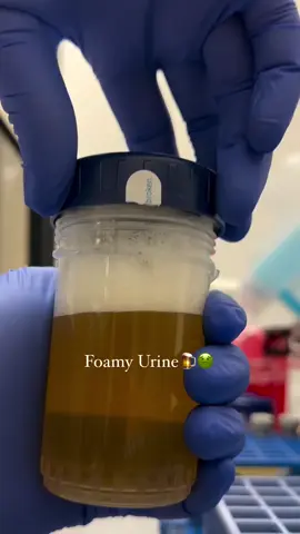 foamy urine in lab 🤢#healthcare #medicinemedia#fyp #media #LabHumor #ScienceComedy #LabLife #FunnyLabMoments #ScienceJokes #ResearchLife #LabFails #ScientistsAtWork #LabChronicles #ExperimentGoneWrong #STEMHumor #BehindTheBeaker #LabShenanigans #ScienceLovers #chemistry 
