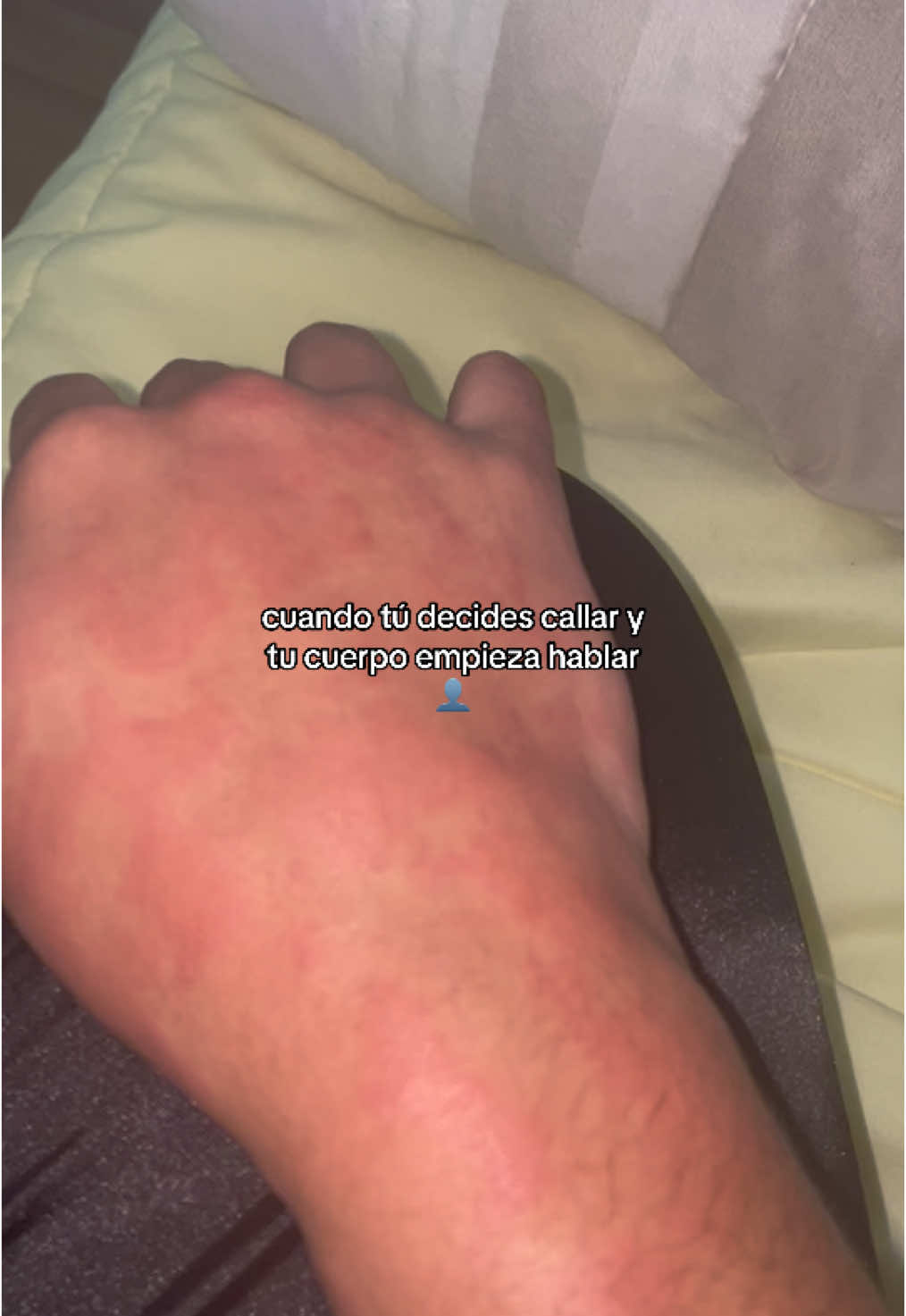 la alergia por estrés es lo peor #foryo #urticariaemocional #paratii #fyp 