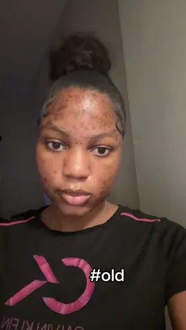 A lot of my dark spots definitely faded#fypシ #foryou #fypシ゚viral #relatable #accutanejourney #accutanejourney #acne #fyppppppppppppppppppppppp #foryoupage 