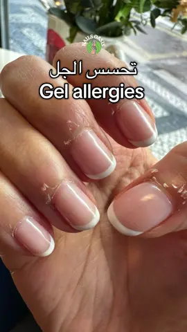 Gel allergies #fyp #foryoupage #viral #صالونات_الرياض #اكسبلورexplore #beauty 