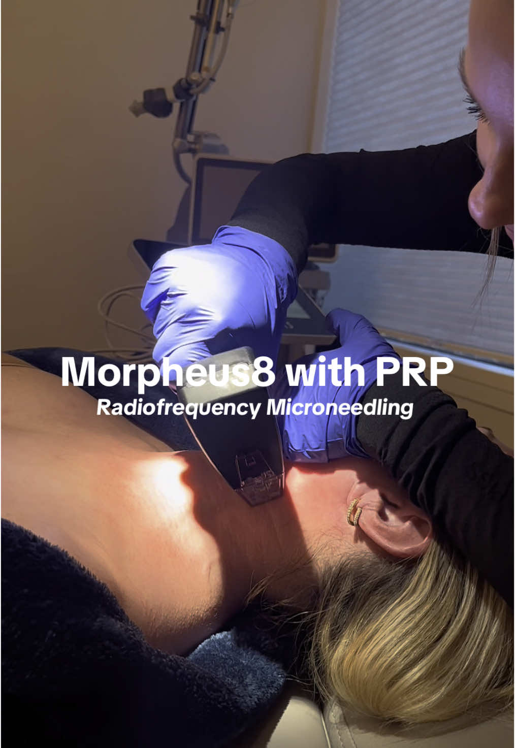 ✨ Looking for a treatment that does it all? Our year-round favorite, Morpheus8 with PRP, offers powerful results for both the face and body. Best results seen in a series of 3 treatment, every 4-6 weeks apart. 🌟 Adding PRP (Platelet-Rich Plasma) supercharges your results—using your body’s natural growth factors to accelerate healing, reduce inflammation, and deliver faster, more dramatic improvements compared to surface-level treatments. 💜Visit our website or call us to book your Morpheus8 appointment.  #medspa #celebrity #treatment #raleigh #nc #cary #acnescars #Morpheus8 #PRPfacial #SkinTightening #CollagenBoost #MicroneedlingWithRF #SkinTransformation #PostPregnancySkin  #StretchMarkTreatment  #AllInOneTreatment #antiaging 