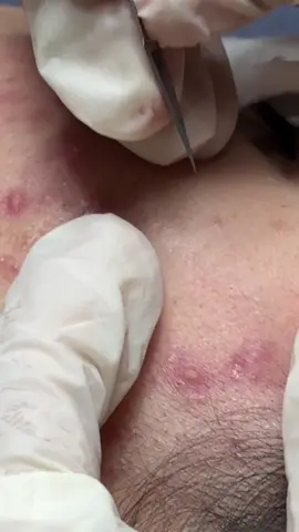 “𝙈𝙪̣𝙣 𝙠𝙝𝙤̂𝙣𝙜 𝙩𝙪̛̣ 𝙨𝙞𝙣𝙝 𝙧𝙖 𝙘𝙪̃𝙣𝙜 𝙩𝙪̛̣ 𝙢𝙖̂́𝙩 𝙙𝙞“ Khách em nhớ đi lấy mụn định kì 2-3 lần/tháng nhé. Hạn chế tình trạng lỗ chân lông bị to, và mụn sẽ sâu và khó nặn hơn‼️ 𝐊𝐇𝐔𝐘𝐄̂́𝐍 𝐌𝐀̃𝐈 𝐋𝐎̛́𝐍 dành cho chị em da mụn nhiều vào khung giờ 19h-22h từ thứ 2 đến thứ 6 👇🏻👇🏻👇🏻  𝐏𝐄𝐄𝐋 𝐌𝐔̣𝐍 𝐙𝐀́ 𝟑𝟗𝟗𝐤 -> 𝟒𝟗𝟗𝐤/ 𝐁𝐔𝐎̂̉𝐈 (tặng kèm nặn mụn và kem dưỡng). Khách quan tâm inbox em tư vấn ạ.