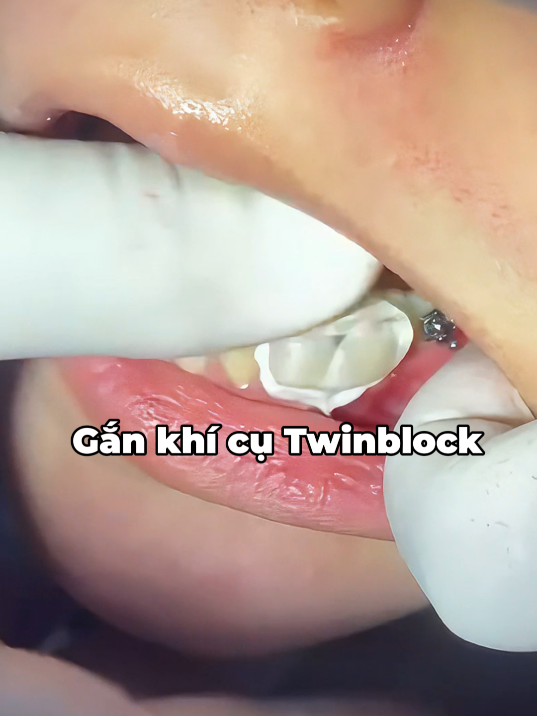 Gắn khí cụ Twinblock#no1dental #nhakhoano1danang #nhakhoano1 #nhakhoadanang #twinblock