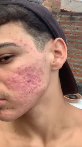 Com certeza eu tive o melhor glow up sobre acne 😍❤️  . . . . . . #acne #acnetreatment #acneskin #GlowUp #autoestima #fyyyyyyyyyyyyyyyyyyyyyyyyyyyyyyyyyy #explore #roacutan #isotretinoina #cuidadoscomapele #fyp #espinhas 