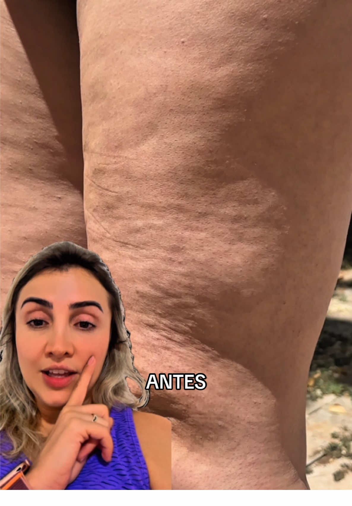 A autoestima tá agradecendo! #celulite #celulites #lipedema #drenagemlinfatica 