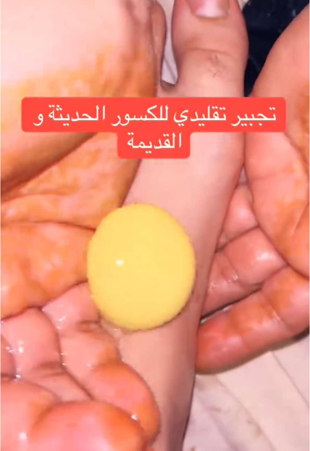 بيض و حناء فقط لتجبير الكسور القديمة و الحديثة طريقة تقليدية 