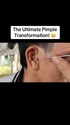The Ultimate Pimple Transformation! #pimplepop, #skincare, #acne, #healthytips, #viral  #creatorsearchinsights 