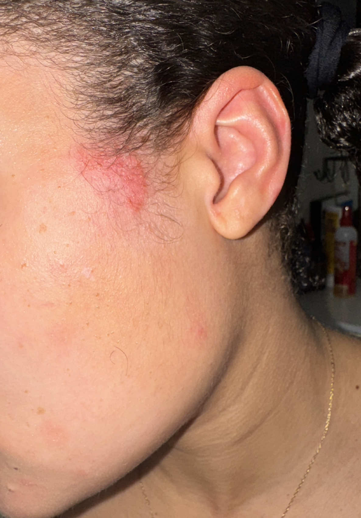 My Dermatologist finally gave me products to help clear my facial psoriasis and help keep it under control. #skin #psoriasis #psoriasistok #skintags #dermatologistrecommended #dermatologist #fyp #skincare 
