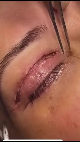 PLÁSTICA DOS OLHOS: PALPEBRAS CAÍDA E CIRURGIA BLEFAROPLASTIA.#GIRUGIA  #PALPEBRASCAĪDA .