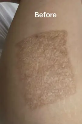 Amazing results after 1 session on skin grafting scar client will need to do a few more sessions to lighten the scar to match her skin tone #inklessstretchmarksremoval #confidence #australia🇦🇺🇦🇺🇦🇺🇦🇺sydney #paramedicaltattootraining #camouflagetattoo #yourwirthit #noninvasive #selfworth #mocropigmentation #skin #collagen #stimulates #flypシ #surgicalscars #skinrepair #takeaction #skingrafting 