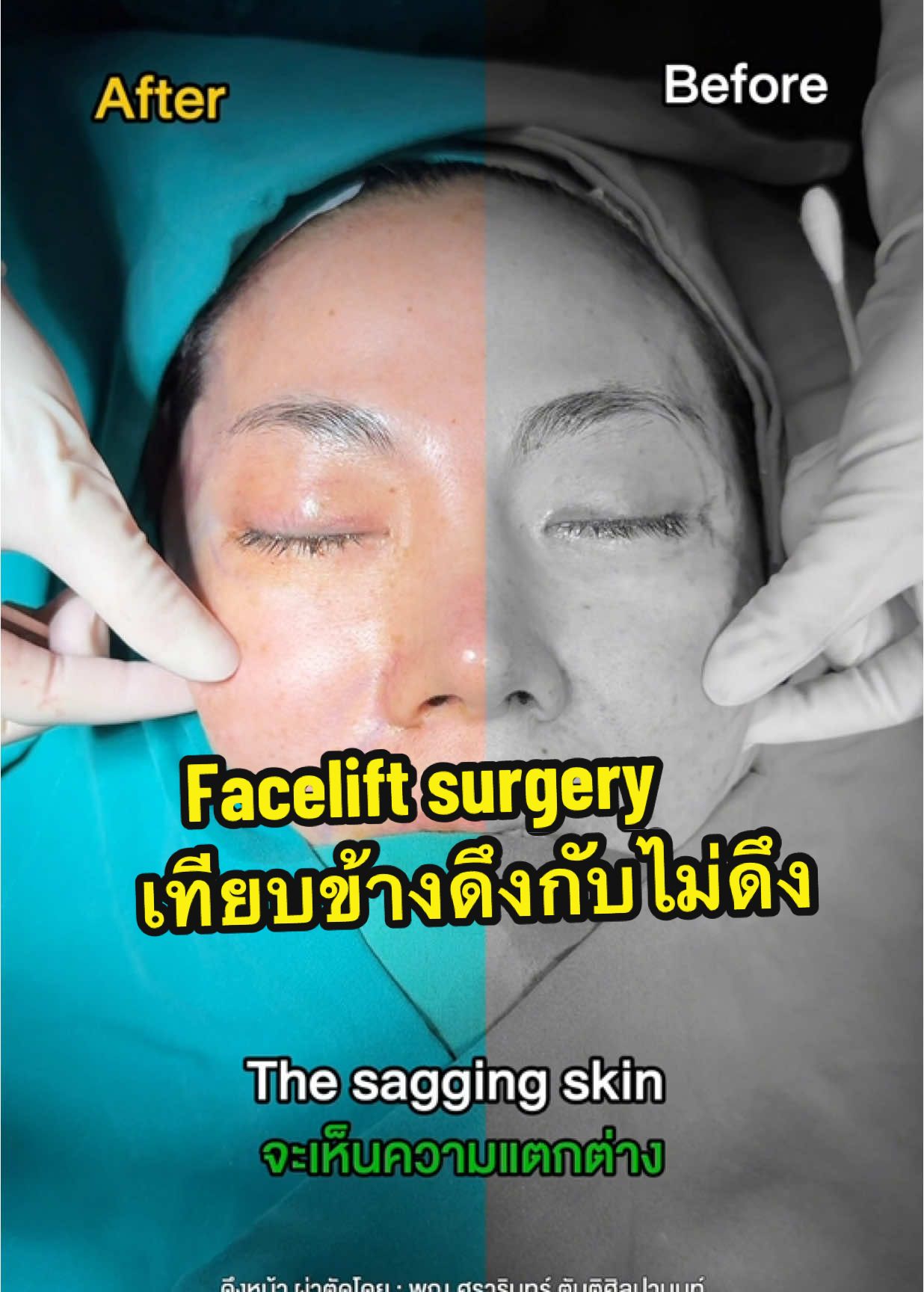 คลิปนี้เทียบให้เห็นเลยว่าข้างที่ดึงกับไม่ดึงแตกต่างกันมากแค่ไหน In this video I’m gonna show you what you can expect after my deep plane facelift. #หมอเฟิร์นnsc #หมอเฟิร์นดึงหน้า #หมอเฟิร์นfacelift #facelift #nscclinic 