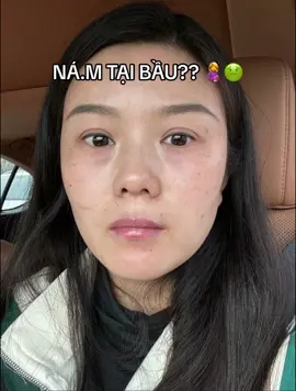 Nỗi lo âu về nám của các mẹ bầu nay đã có cách #trinamtannhang #xuhuong #foryou #viral #cafuné #tannhang #fyp