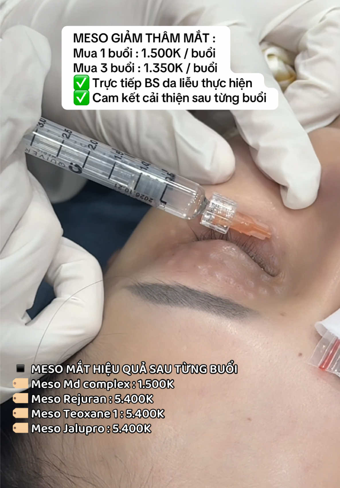 Meso giảm thâm mắt hiệu quả rõ sau từng buổi #phongkhamdalieuqclinic #qclinic #pkckdalieuqclinic #meso #mesothammat 