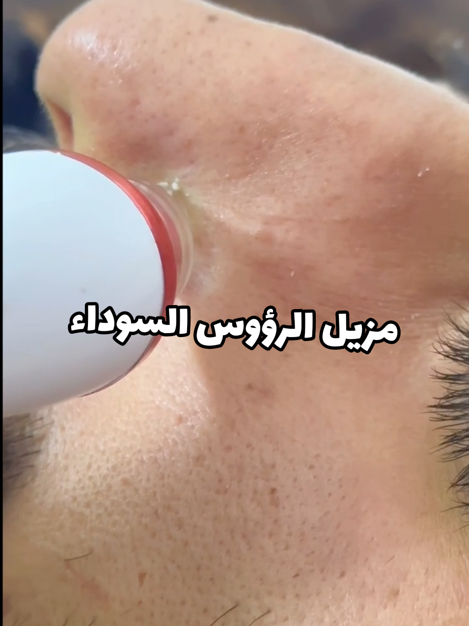 مزيل الرؤوس السوداء الاستخدامات: يستخدم لإزالة وشفط الرؤوس السوداء من البشرة بفعالية. يساعد على تنظيف المسام بعمق وتحسين مظهر البشرة. مناسب للاستخدام المنزلي للعناية بالبشرة بديلاً عن جلسات العناية في العيادات. المميزات: مزوّد بـ 6 رؤوس مختلفة لتناسب كافة أنواع البشرة والمناطق المختلفة في الوجه. يحتوي على 3 أوضاع للشفط مخصصة لأنواع البشرة (دهنية - عادية - جافة). شاشة رقمية LED تعرض نوع الشفط المستخدم ومستوى البطارية. تصميم مريح وخفيف الوزن للاستخدام السهل والمريح. شحن سريع بمدة 90 دقيقة فقط. أبعاد المنتج: ‎ الطول 20 سم، العرض 4 سم، الارتفاع 4 سم. أبعاد الغلاف: ‎ 5 × 9 × 22 سم. ملاحظات: يُنصح بفتح المسام بالبخار قبل الاستخدام لنتائج أفضل. لا تستخدم الجهاز على نفس المنطقة لأكثر من 3 ثوانٍ لتجنب التهيج. يتم شحن الجهاز باستخدام كابل USB (يأتي في العلبة). مناسب للرجال والنساء. الملاحظات: لم يتم ذكر المنشأ لم يتم ذكر حجم البطارية #foryoupage #الرؤوس_السوداء 