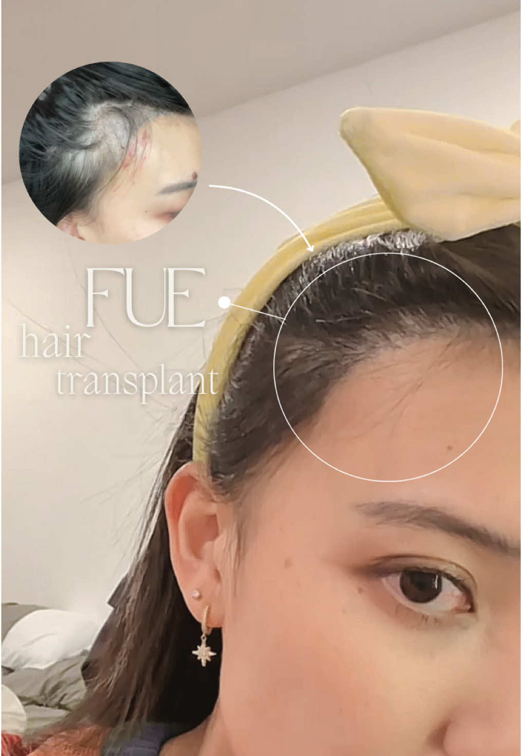 Post-surgery results you’ve been waiting for—this is what FUE can do 👇 Wondering what happens after your FUE hair transplant? Here's a breakdown of what to expect as you heal and your new hair starts to grow: 🔹 1 Week After Surgery •Most scabbing and redness around the grafts begin to fade •Donor and recipient areas are in early healing mode •Important to follow aftercare guidelines strictly 🔹 1 Month After Surgery •Temporary shedding of transplanted hairs (this is normal!) •Follicles enter a resting phase beneath the scalp •New growth isn’t visible yet—but it's coming! 🔹 8 Months After Surgery •Visible new hair growth with improved density •Hair becomes thicker and more natural-looking •The shape of your new hairline becomes more defined •Donor area fully healed with minimal to no scarring ✨ Final results can continue to improve for up to 12–18 months, depending on your body’s natural growth cycle. #FUERecovery #HairTransplantJourney #FUEHairTransplant #HairRestoration Contact us now for a FREE Consultation! WhatsApp/Kakao: +82 (0)10-5920-5546 consult@seoulguidemedical.com   Related Video: https://www.youtube.com/watch?v=aLldqvioGeM&t=3s   Watch our YouTube Channel: https://www.youtube.com/@SeoulGuideMedical   📍 Heights Building, 151 Teheran-ro, Gangnam-gu, Seoul #seoulguidemedical #sgm #koreanskincare #koreaskincare #skincare #koreaplasticsurgery #koreanplasticsurgery #plasticsurgerykorea #gangnamplasticsurgery #seoulplasticsurgery #plasticsurgeon #medicaltourism #koreamedicaltourism #medicaltourismkorea #gangnam #seoul #korea 