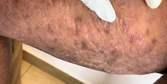 Stretchmark Treatment  #plasmafibroblast #stretchmarktreatment