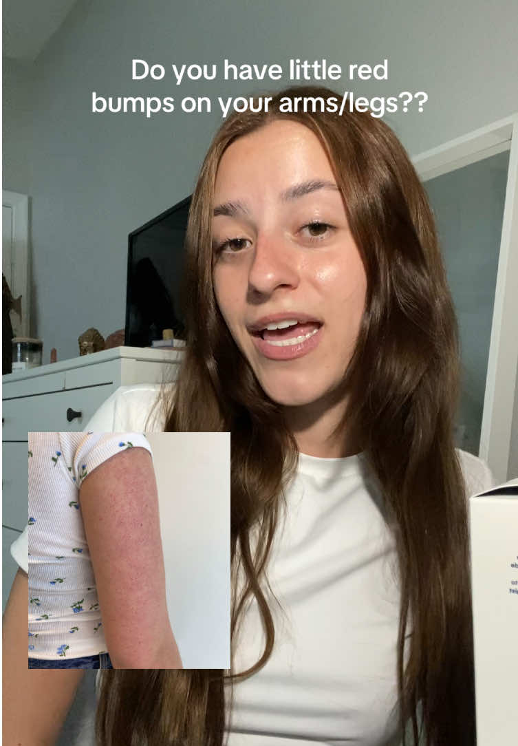 Do you suffer from keratosis pilaris or KP? These are little red bumps that usually appear on the arms and legs and can easily be treated with lactic acid or urea creams!! #keratosispilaris #dermatology #skincare #skincareroutine 