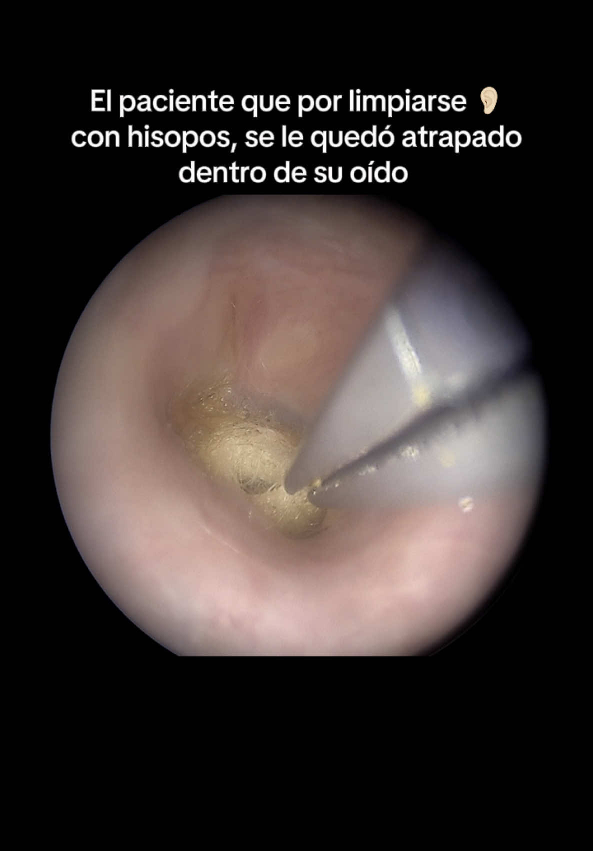 Un storytime de por vida! 😅👂🏻 #otorrinolaringologo #fy #satisfying #satisfyingvideosdaily #otorrino 