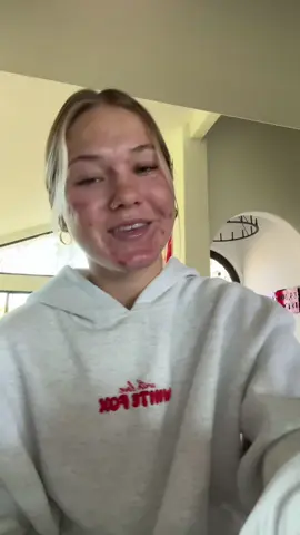 YAYYYY IM SO EXCITED #acne #accutane 