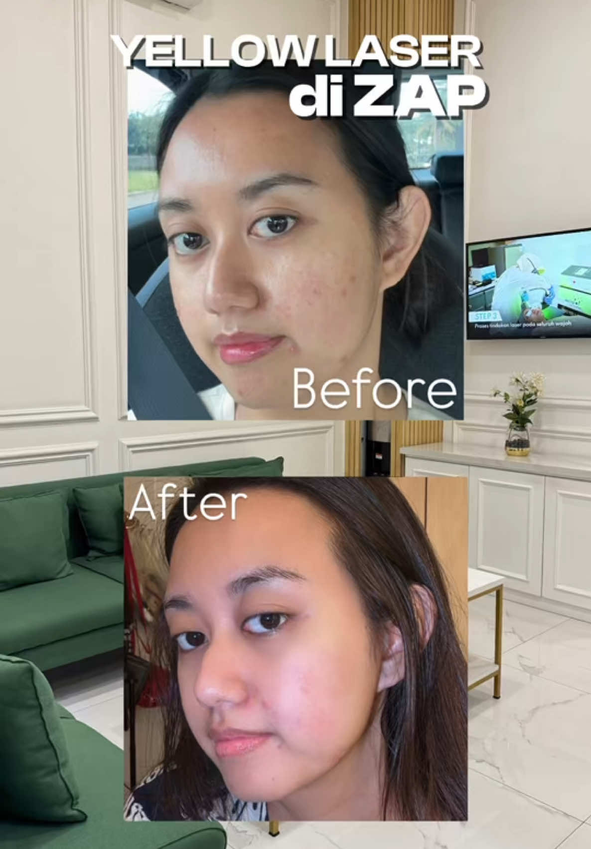 Akhirnya perawatan lagiii di  @ZAP Clinic  🙆🏻‍♀️✨ #RekomendasiZAP 