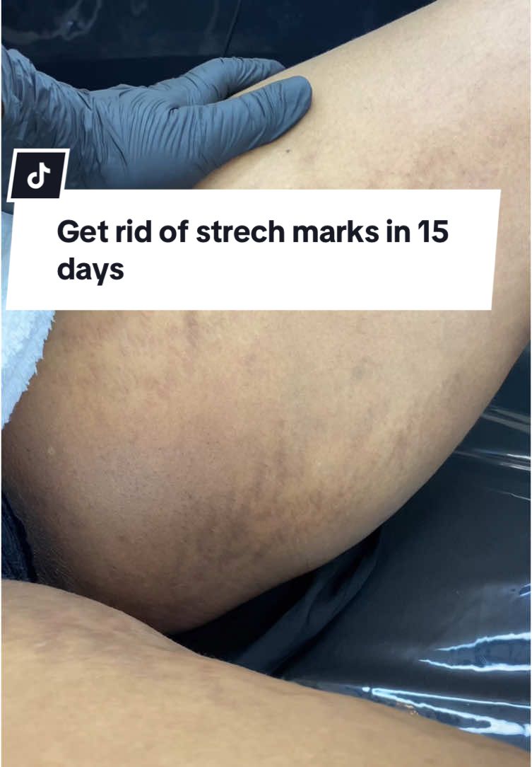 Strech marks transformation🌟  Get rid of pregnancy strech marks,and dark inner thighs in just 1 session, however,  🌟clients can expect optimal results after a series of 1-3 treatments  🌟Approx. 7-13 days downtime  #strechmarks #strechmarkremoval #pigmentation #hyperpigmentation #acneskin #darkmarks #brownskingirl #unevenskintone #fypp #fyp #viralvideos #trendingvideo #trendingsong #chemicalpeel 