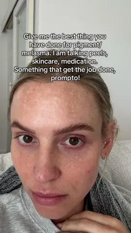 Help me! After babies my pigmentation is so bad! #melasma #melasmatreatment #pigmentation #hyperpigmentation 