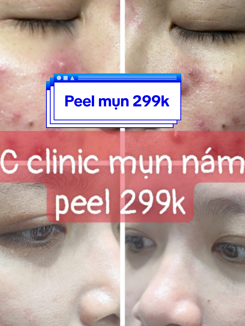 Peel mụn 299k #bsdalieuthammy #mụn #peel 
