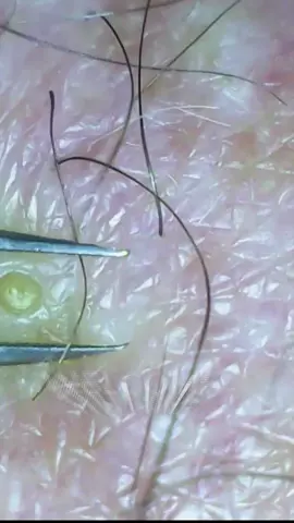 WORLD BIGGEST INGROWN HAIR #pop #pimple #satisfying #fyp