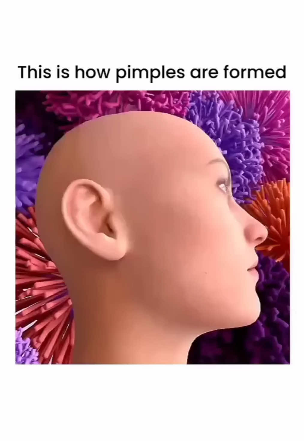 ⸻ “Ever wondered how pimples really form? Watch the science behind clogged pores, oil, bacteria & inflammation in action!” #PimpleFormation #SkincareScience #AcneExplained #ClearSkinJourney #DermTips