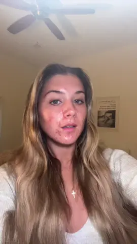 Probably bc it’s Thursday and good things are happening to me rn so I’m not fixated on it for once lol #realisticroutineswithken #confidentwithken #facerealityskincare #confidencetips #acneisnormal #skinupdate #acnetriggers #acneskin 