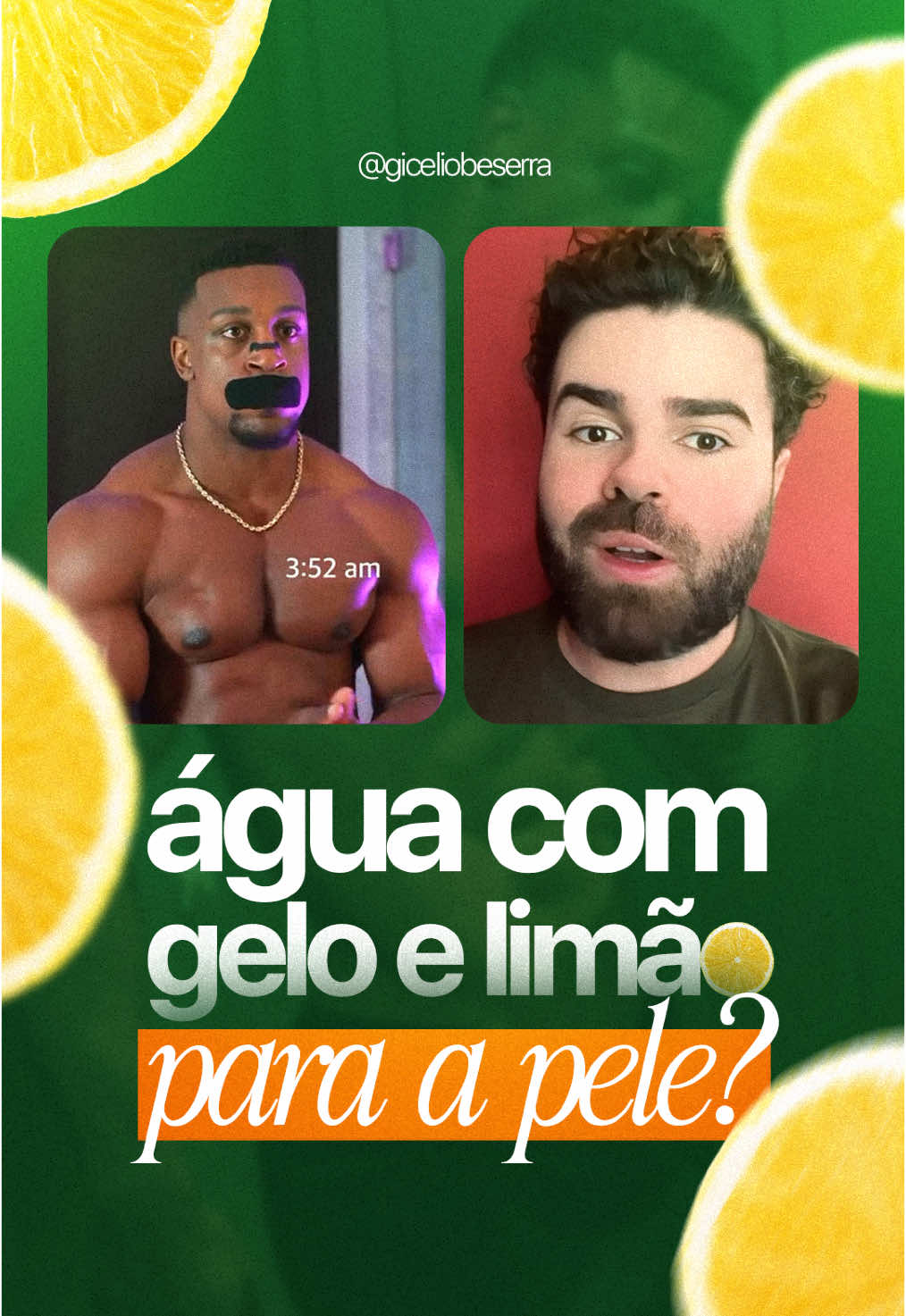 A rotina do Ashton Hall ficou bem famosa nos últimos dias né? Mas minha gente, mergulhar a cara em água com limão não é skincare tá? 😅🍋 Água gelada no rosto? Aprovadíssima! inclusive super recomendo se você quer fechar os poros, dar um efeito tensor na pele, além de que ela reduz as olheiras momentaneamente e pode te ajudar até com a tua ansiedade! 🙏 MAS PELO AMOR DE DEUS, LIMÃO NÃO! ⠀ O limão em contato com a pele + exposição à luz (mesmo a indireta) pode causar queimaduras na tua pele, manchas escuras e até irritação severa na região que foi aplicada! Pode parecer chique, mas o resultado pode ser um trauma estético que pode te acompanhar por muito tempo. E NÃO GENTE, limão não é detox facial! Quer potencializar sua skincare com água gelada? Usa só a água, pode colocar gelo, chá de camomila gelado, mas limão é pra caipirinha, não pra sua cara😅 ⠀ Comenta aqui, qual foi a “dica de beleza” mais doida que você já viu na internet? 👇🏽 ⠀ CRM PB 10148 / 9100 RN Gicelìo Besérra - Clínico Geral #foryou #ashtonhall #skincare #dicas #cuidados #pele 