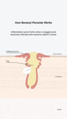“Benzoyl Peroxide vs acne—see how it kills bacteria, unclogs pores & clears skin!” #BenzoylPeroxide #AcneTreatment #SkincareScience #PharmacyTips #HealthifyPharmacy