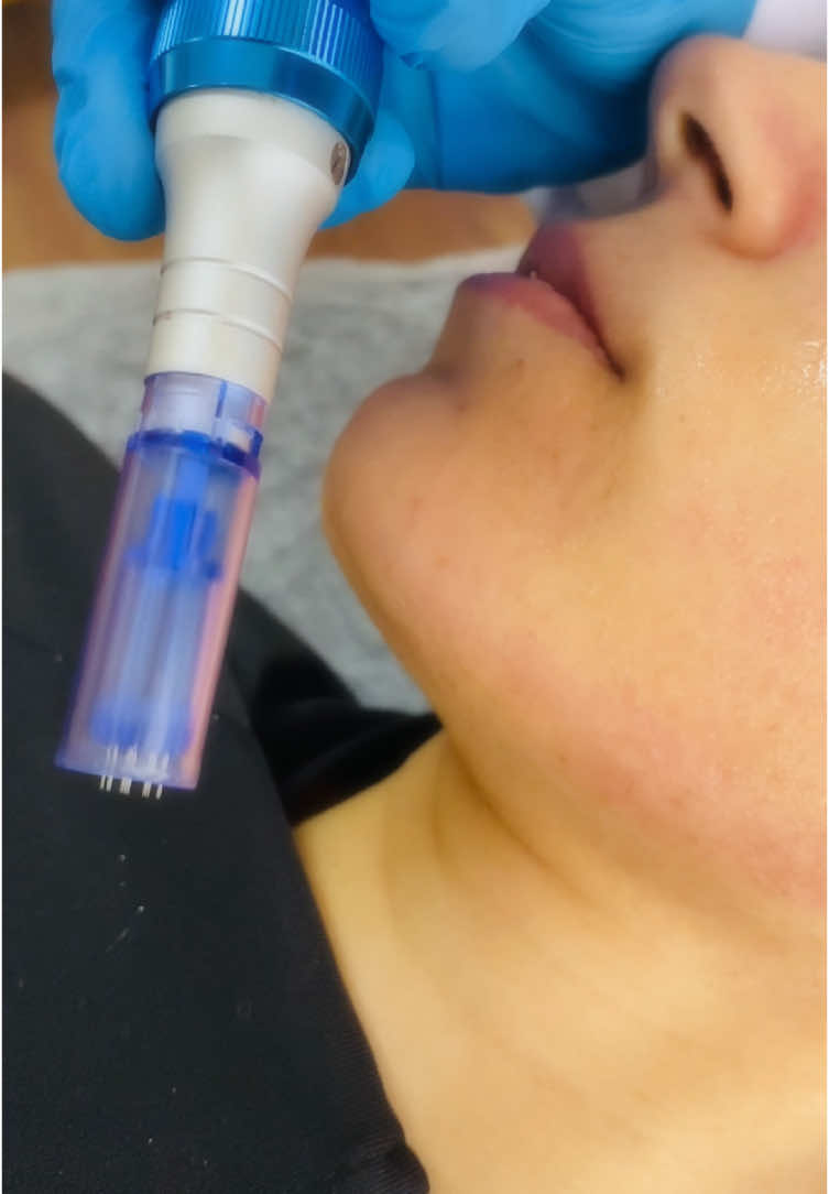 Dermapen işlemi kısaca👉🏻cilt yenileme uygulamasıdır. Kolajen indüksiyon tedavisi olarak da bilinen dermapen ile cilt küçük iğnelerle delinerek cildin elastin ve kolajen üretmesi sağlanır. Böylelikle cildin daha genç ve iyi görünmesi hedeflenir #dermapen #bilecikbozuyük #bursa #eskişehir #fyp