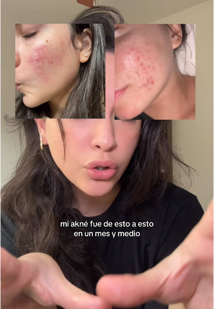 Estos son los resultados de usar sebo 🧈 de res una crema natural utilizado por siglos para tratar manchas, acné, cicatrices, piel seca, etc si también quieres probarlo dale clic al enlace. 🤳  evil goods ecuador evil goods crema ecuador sebo de res ecuador crema de sebo de res en ecuador #evilgoods #seboderes #beeftallow #SkinCare #cuidadodelapiel #ecuador #tiktokshop 