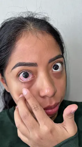 LA PEOR ALERGIA 🤧😩 #alergias #rinitisalergica #alergia #allergyseason 