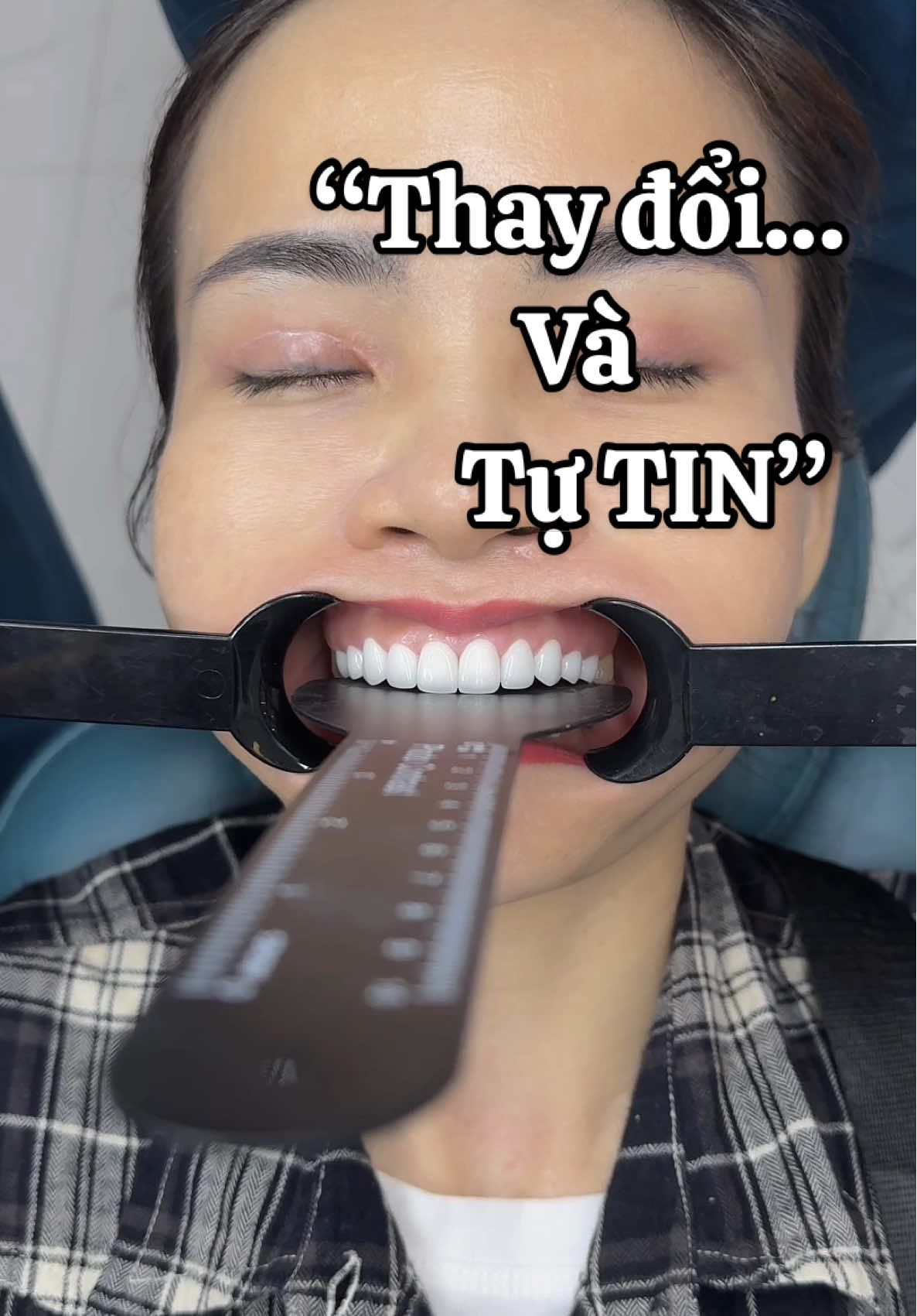 Răng sứ liệu có xấu như mọi người nghĩ….#lamdep #rangsuthammy #rangsu #xuhuong #nhakhoathammyquoctedelia 