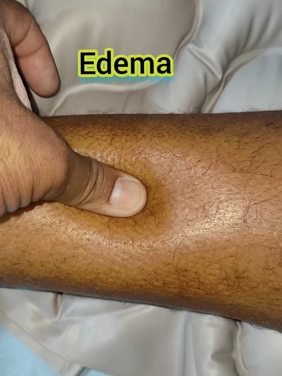 Swelling of legs or edema of legs in a patient with chronic liver disease. #edema #oedema #chronicliverdisease #hepatitis #livercancer #hepatocellularcarcinoma #healthandwellness #health #Jaundice #layyah #pakistan #doctor #viralvideo 
