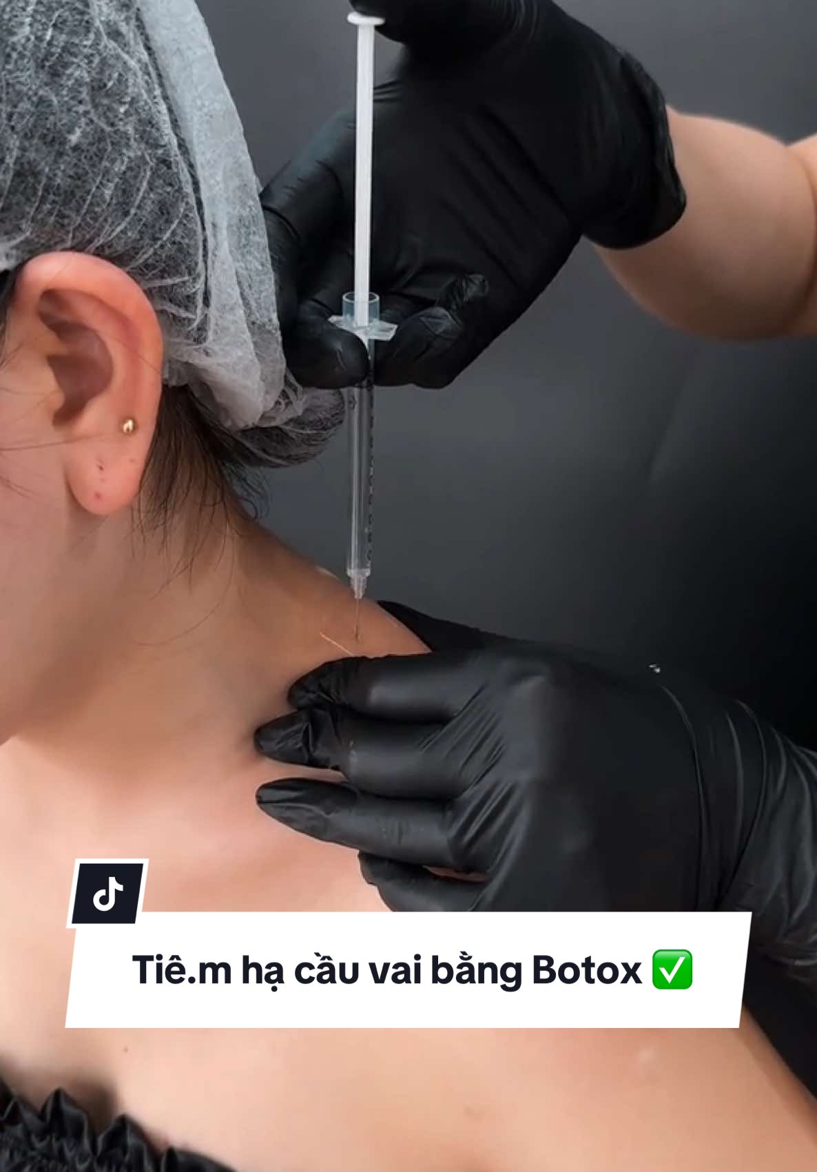Tiê.m hạ cầu vai giúp vai thon gọn, giảm nhức mỏi vai gáy, tác dụng 2 trong 1✅✅✅#filler #botox #tiemmoifiller #moibaby #tiemcam #tiemthaiduong #tiemmeso #tiembap #tiemthongonham #tiemmababy #tiemfulface #fillerbotox 