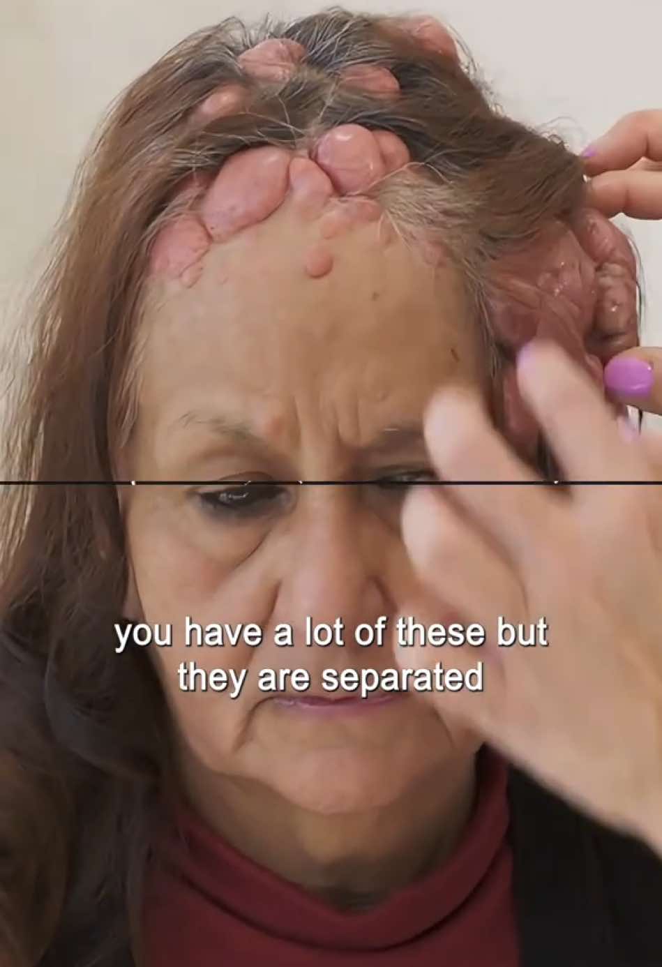 Part 3#pimplepopping #drpimplepopper #skincareroutine 