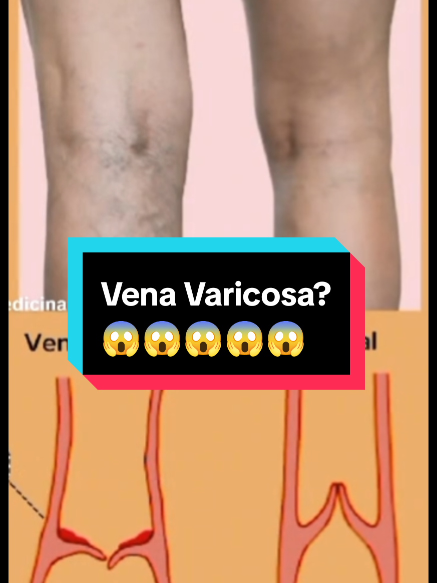 Sufres de várices y no sabes qué hacer? Mira esto👇☺️🌱 #California #mississippi #Alabama #louisiana #arizona #nevada #venasvaricosas #pieshinchados #retenciondeliquidos #varicesyarañitas #piernaslindas 
