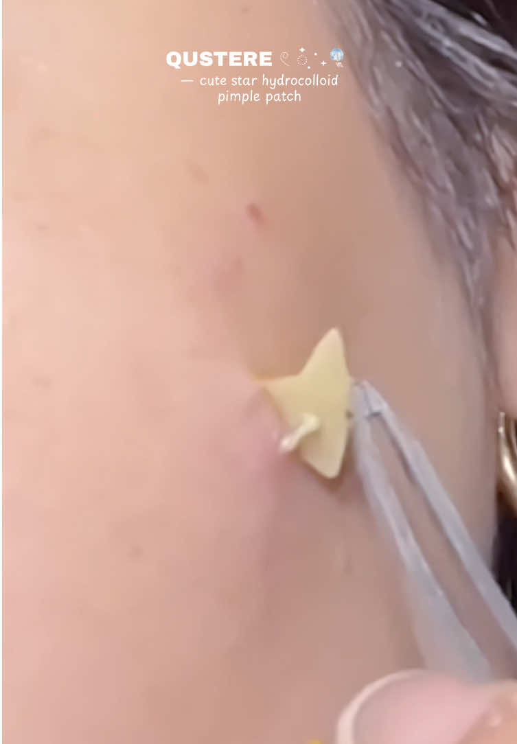 BUY HERE:@Nessa Avelino⬅️ — obsessed with these cutie star pimple patches! 😩❤️ #hydrocolloidpatches #pimplepatch #acnepatch #starpimplepatch #skincare 