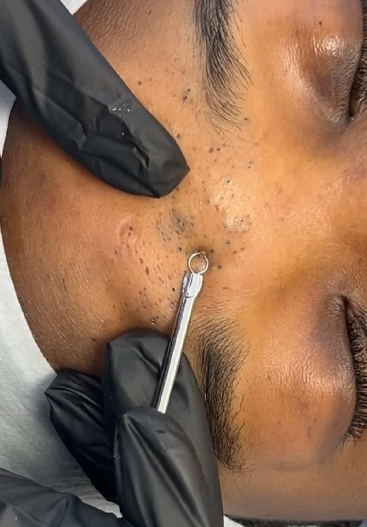 Extraction time!!!  #skincare #skintok #skincareproducts #aestheticvideos #blackheads #facial #fyp #facialtreatments #monthlymaintenance 
