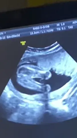 IT’S A BOY! A HEALTHY BABY BOY! 20 WEEKS ULTRASOUND.  🧡🦊👣 • • • #fyp #fyppoppppppppppppppppppppppp #ultrasound #babyboy #tiktok #newmom #pregnancy #momtok #newbaby #newborn #20weeks #pregnancyjourney #momtobe #boymom #mom #mother #baby #prenatal #tiktokviral 