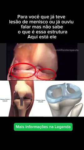 Já ouviu falar em lesão de menisco mas não sabe exatamente o que é? O menisco é uma estrutura, como mostra na imagem, que fica no joelho e é muito importante. Ela funciona como uma 