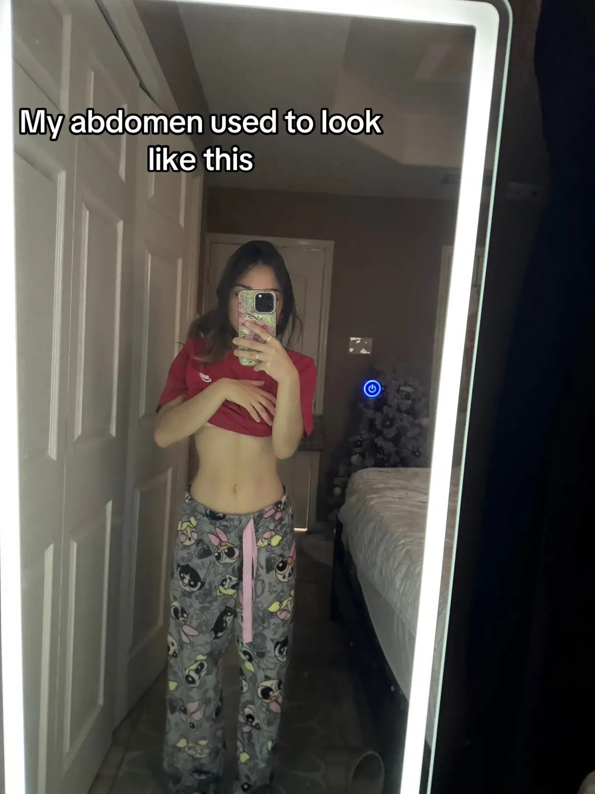 I recently started following around @Emma Britt case since i see myself a lot in her and wanted to speak about this. I never thought i would find myself in a position like this but here i am ready to speak about it all.🤍 My stomach as of now keeps extending and I have learned how to deal with it and want to help other people who go through these things. #bloating #bloatingstomach #giproblems #distention #abdominaldistension #hotpeoplehavestomachproblems #ibs #stomachproblems #constipation #endometriosis #ovariancystawareness #pelvicfloordysfunction #urinaryretention #chronicallyill #bodypositivity #buildingconfidence 