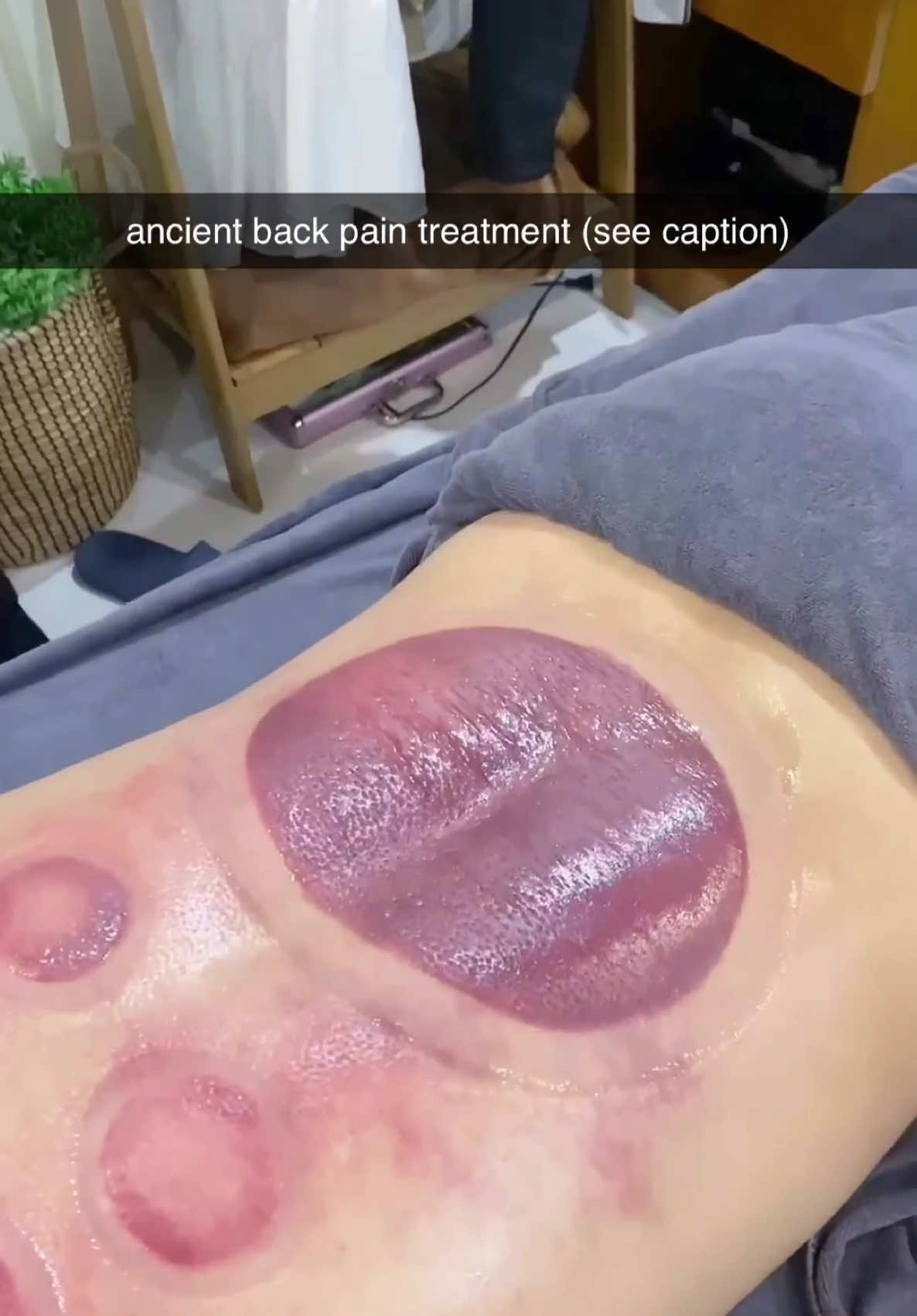 Cupping helps your muscles feel better and less tight. It can make pain go away faster. It also helps your body relax and feel calm. (via longkyasmr/yt)