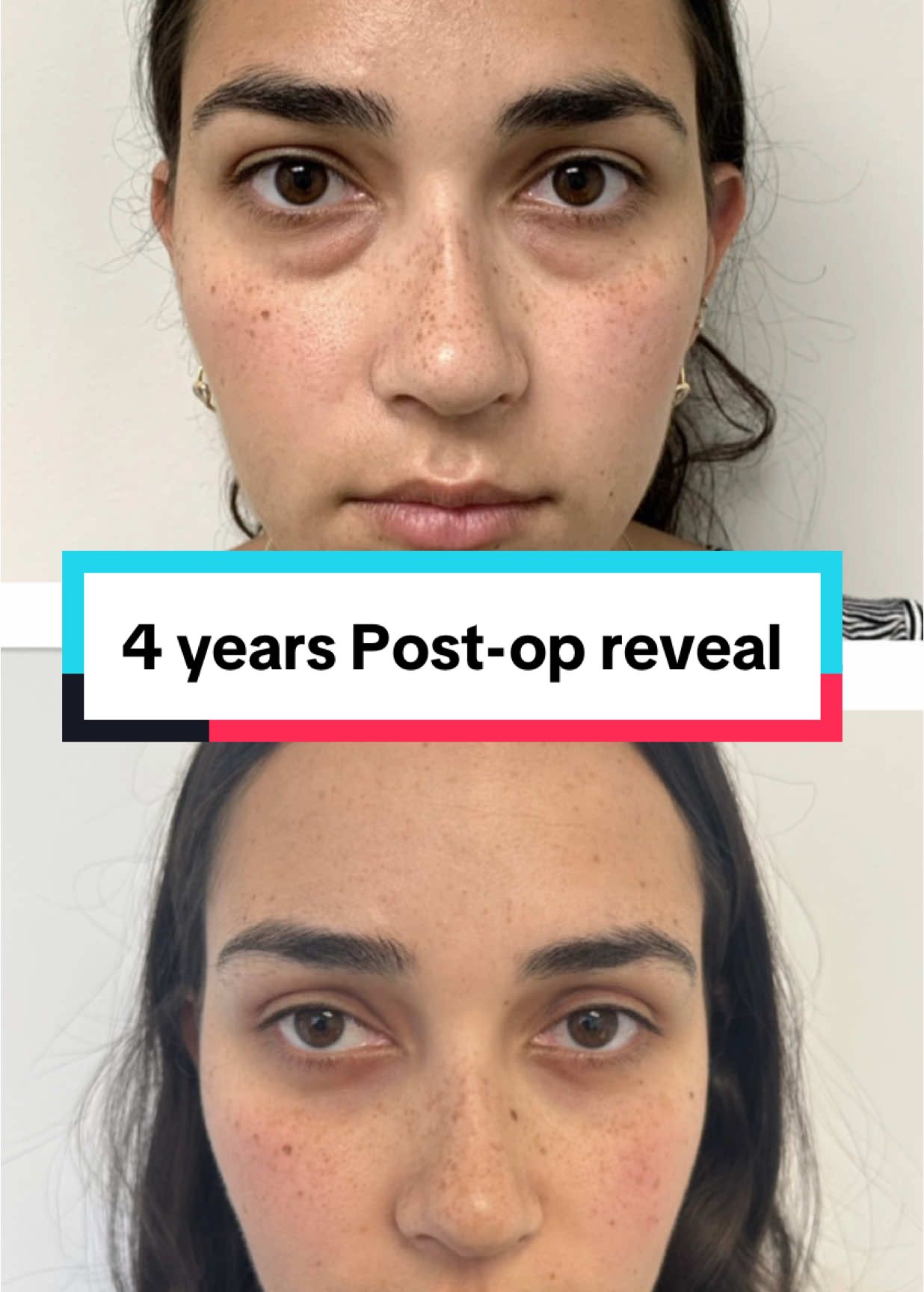 How Long Does Lower Blepharoplasty Last? Here’s a great example: This beautiful young patient of mine is 4 years post-lower Blepharoplasty, and her results are still going strong — with no signs of eye bags coming back. Lower blepharoplasty results can last decades, and in some cases, the concerns don’t come back at all. Longevity depends on factors like skin quality, aging, and lifestyle, but with the right care, the results can be long-lasting and incredibly natural. For more info or to book a consultation: 🌎www.torontoeyelidsurgery.com ☎️416-962-5005 📫info@torontoeyelidsurgery.com #blepharoplasty #eyebags #hollows #plasticsurgeonsoftiktok #beforeandafter #ontario 
